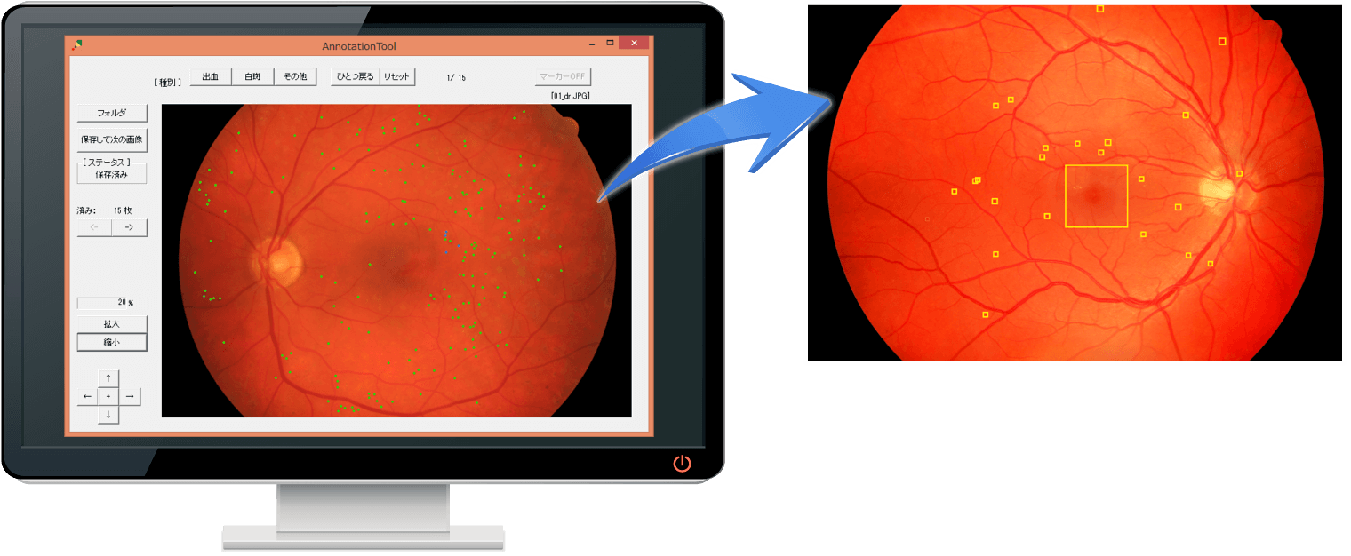 機械学習による眼底写真に見られる糖尿病網膜症病変の検出例